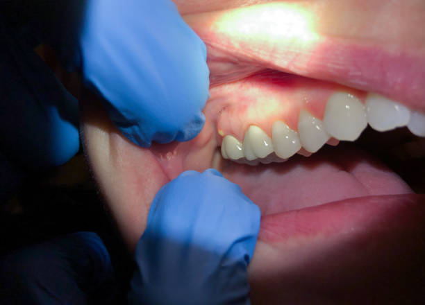 Best Lost Filling or Crown Replacement in South Woodstock, CT